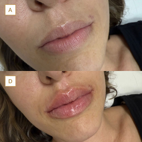 innova-laser-beauty-medicina-estetica-antesydespues-1