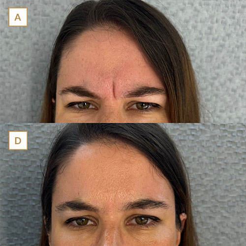 innova-laser-beauty-medicina-estetica-antesydespues-2