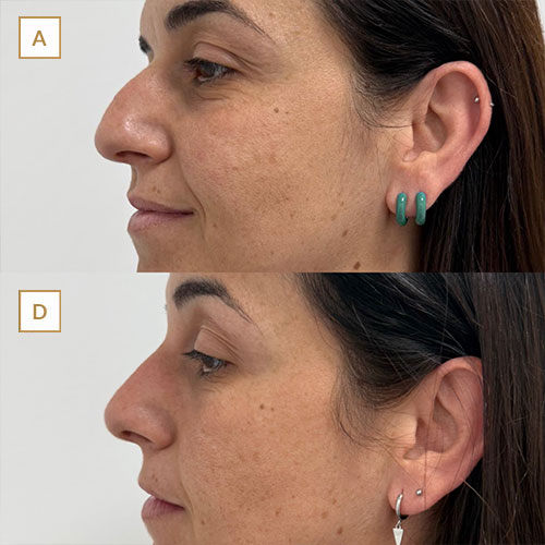 innova-laser-beauty-medicina-estetica-antesydespues-3