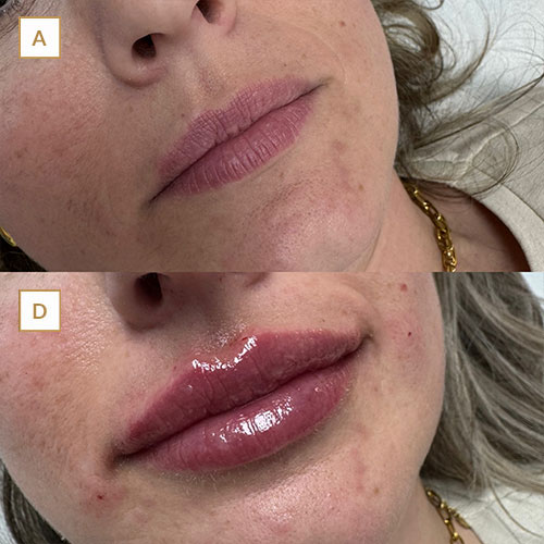 innova-laser-beauty-medicina-estetica-antesydespues-4