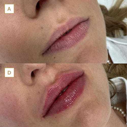 innova-laser-beauty-medicina-estetica-antesydespues-5