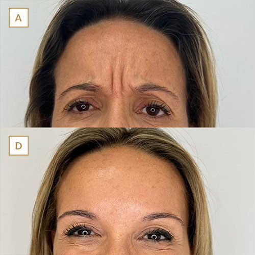 innova-laser-beauty-medicina-estetica-antesydespues-6