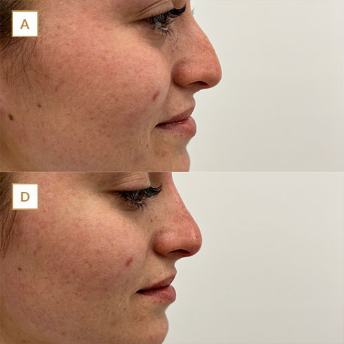 innova-laser-beauty-medicina-estetica-antesydespues-7